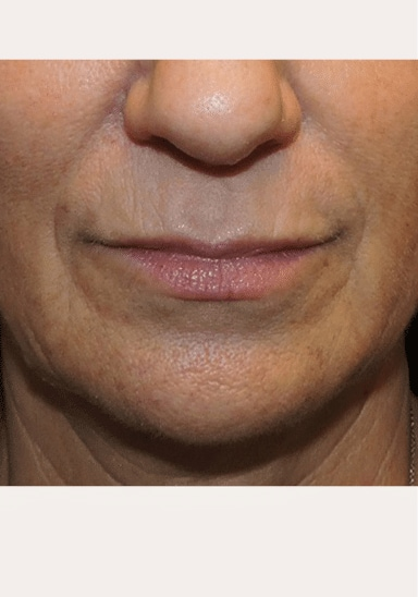 After Juvederm lip filler — natural, enhanced lips