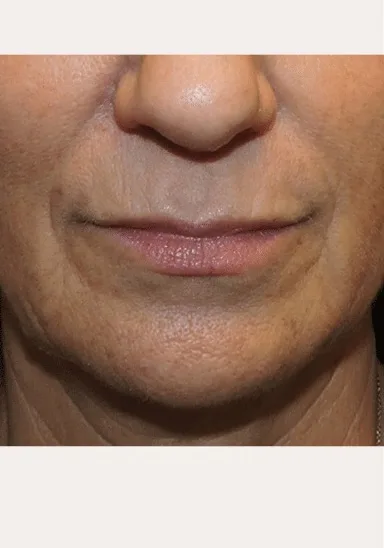 After Juvederm lip filler treatment — natural results for Independence patient