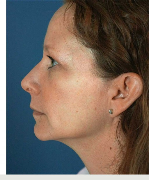 After Juvederm cheek filler — restored volume and contour