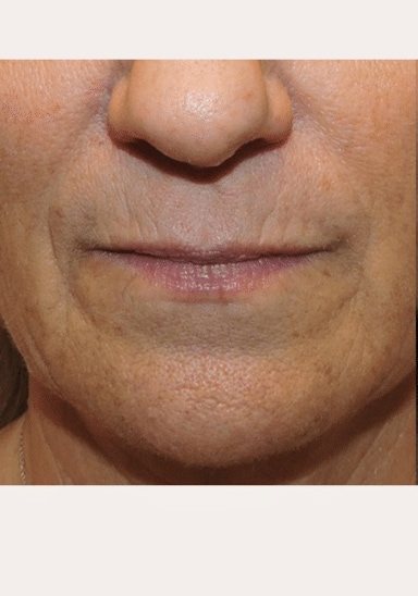 Before Juvederm lip filler treatment — KC Med Spa Group patient