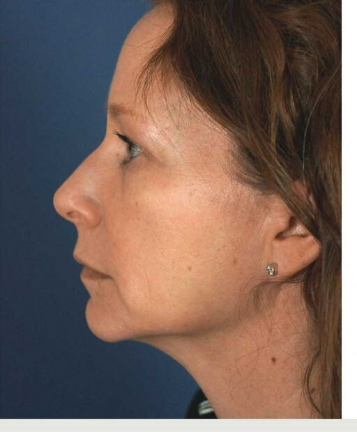 Before Juvederm cheek filler — volume loss, flatness